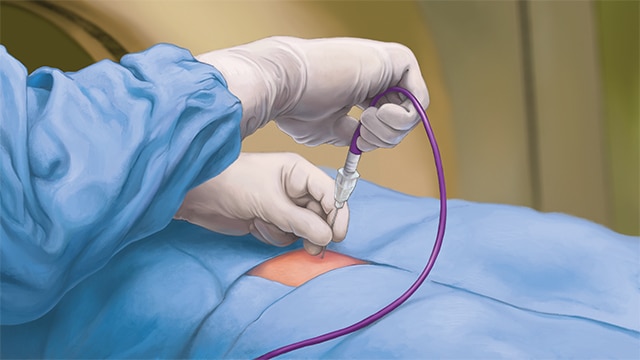 Clinician preparing the Aliya needle during a procedure