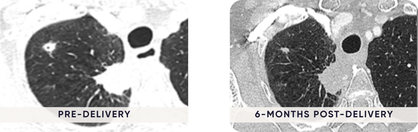 CT image of a lung lesion before Aliya PEF energy delivery